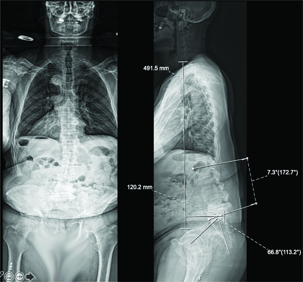 X-ray image of a 6--year-old man demonstrating the effects of flatback syndrome.